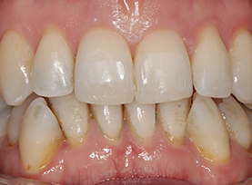 After Treatment